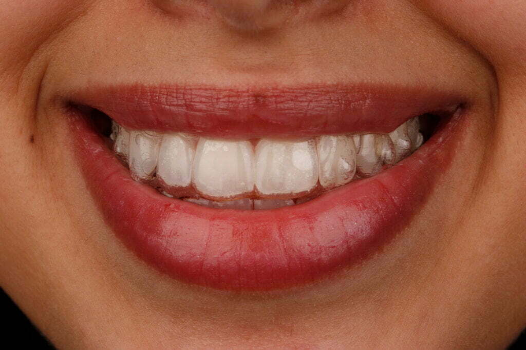 expect after teeth whitening